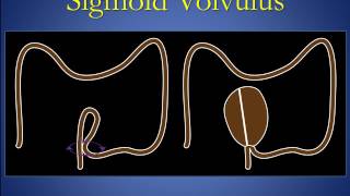 Cecal and sigmoid volvulus version 1 0 edit [upl. by Enala442]