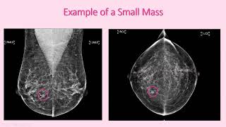 Screening Test Mammography for Breast Cancer [upl. by Airotkiv]