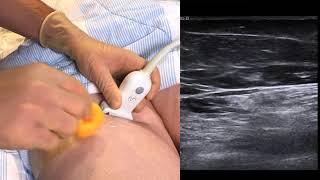 Ultrasound guided saphenus nerve block [upl. by Rutger]