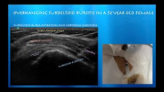 Ultrasound guided Subacromial Injection of an Overhanding Subdeltoid Bursisitis probeultrasoundcom [upl. by Lesirg609]