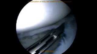 Arthroscopic quotsaucerizationquot menisectomy of Discoid Lateral Meniscus by Dr Mihir Patel Mumbai [upl. by Francene]