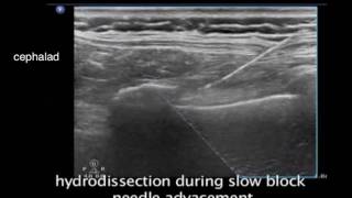 Intercostal Nerve Block [upl. by Ocana]