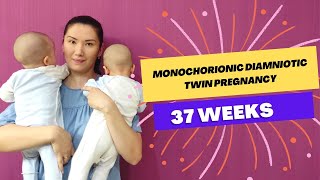 Monochorionic diamniotic twin pregnancy Worries and advice Delivery childbirth in Kazakhstan [upl. by Lexis]