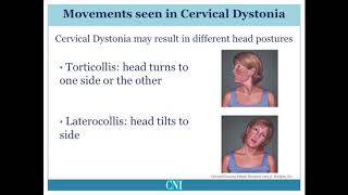 What is Cervical Dystonia [upl. by Ailemap804]