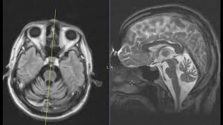 Slurred speech and difficulty walking worse over 6 months [upl. by Gran]