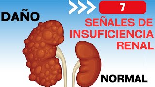 7 señales de que tendrás insuficiencia renal [upl. by Atiuqan]