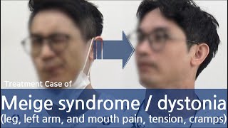 Meige syndrome  Dystonia facial oromandibular eyes tongue neck half of body  디스토니아 치료사례 [upl. by Namruht]