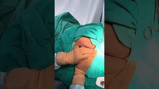 Pilonidal Sinus Pilonidal cyst treatment DrAshishBhanot [upl. by Akeihsat]