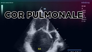 COR PULMONALE 2D ECHO [upl. by Ayam998]