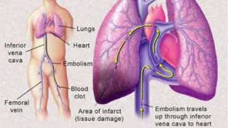 Pulmonary Embolism [upl. by Aehsal]