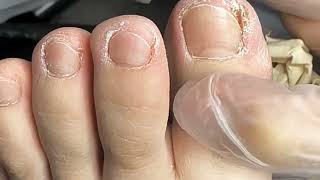 Ingrown Toenail  Impacted Toenail Removal  Toenail Fungus Treatment toenails [upl. by Eintihw]