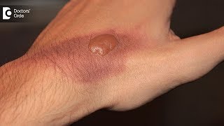 How to treat a burn blister at home Tips to avoid burn scar  Dr Pavan Murdeshwar [upl. by Derriey]