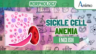 Sickle Cell Disease  Histo pathology  RBC Morphologies  English [upl. by Fabiolas138]