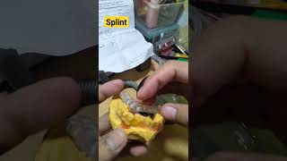 Dental Splint Bite or Occlusal splint [upl. by Sulakcin200]