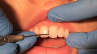 Periodontal Probing [upl. by Novihs]