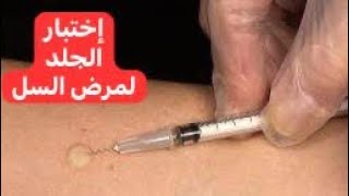 إختبار الجلد لمرض السل Tuberculin Skin Test [upl. by Peddada]