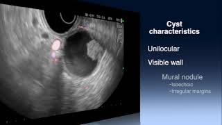 EUS of mural nodule in pancreas cystic tumor by Dr Dario Ligresti [upl. by Enohpets]