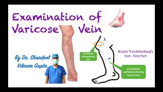 Examination of Varicose Vein for MBBS MS Surgery medical students [upl. by Keon]