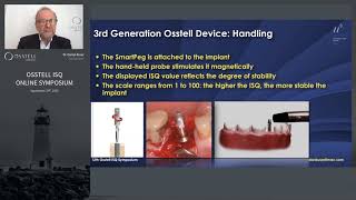 How to measure implant stability [upl. by Treb357]