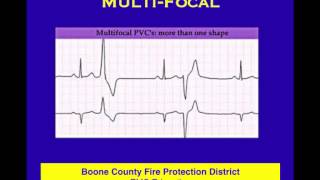 ECG 12 Ectopics [upl. by Easlehc710]