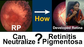 Retinitis Pigmentosa  How she got useful vision  Medical Improvement  DrSasi [upl. by Jewelle212]