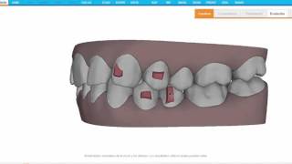 Invisalign Tips to solve a Deepbite and a Class II malocclusion [upl. by Anitnoc]