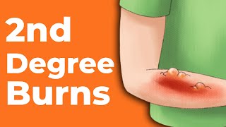 2nd Degree Burns How to Treat Them  Wound Care OC [upl. by Eesdnil]