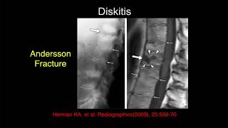 MRI of the Lumbar Spine  Part 7  Lumbar Inflammation [upl. by Ynohtona716]