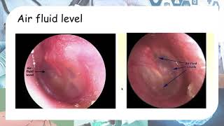 Acute otitis media  Otoscopy findings [upl. by Naleag]