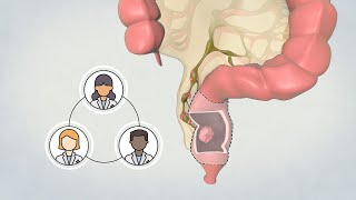 Patient Teaching Low Anterior Resection  Surgical Management of Rectal Cancer  TVASurg [upl. by Kalle514]