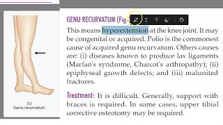 Orthopedics 344 genu recurvatum Polio hyperextension of knee joint [upl. by Norrv945]