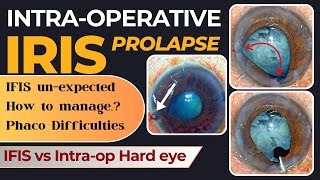 Intraop Iris Prolapse  IFIS unexpected How to manage Phaco Difficulties  Dr Deepak Megur [upl. by Anetsirk]