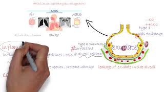 ARDS acute respiratory distress syndromeشرح [upl. by Oivat]