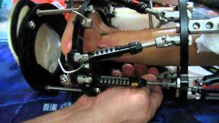 Adjustments on External Fixator [upl. by Barnabas]