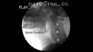 Zenkers diverticulum Barium Swallow [upl. by Llenra895]