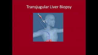 Transjugular Liver Biopsy [upl. by Stacia222]