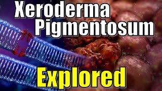 quot Vampire Syndrome quot Xeroderma Pigmentosum DNA Damaged Explained  Effects of UV Radiation on Genes [upl. by Lichter693]