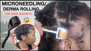 MICRONEEDLINGDERMA ROLLING FOR EDGE GROWTH  Two Month Update  TRACTION ALOPECIA 🚨 NO MINOXIDIL [upl. by Areic]