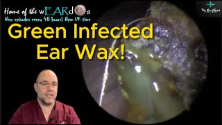 GREEN INFECTED EAR WAX 249 ear earwax earwaxremoval earcleaning asmr fyp foryou satisfying [upl. by Norval704]