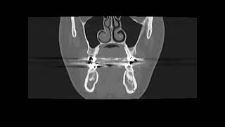 Cementoblastoma [upl. by Heer]