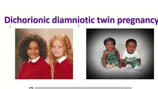 Types of twins pregnancy  Monochorionic diamniotic twins  3D Anatomical Visualization [upl. by Omsare]