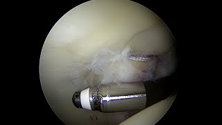 Articular Cartilage with a Grade 3 Injury to the Posterior Acetabulum near full thickness [upl. by Ludovico407]