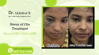 Nevus of Ota Treatment I Qswitch Ndyag laser I Dr Walias Skin and Hair Transplant Clinic [upl. by Tormoria]