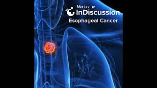 Navigating Esophageal Squamous Cell Cancer From Diagnosis to Treatment [upl. by Nehr]