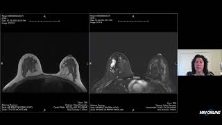 Breast MRI BIRADS Assessment [upl. by Sair]