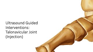 ultrasound Guided Interventions Talonavicular Joint Injection fyp sports sportsmedicine [upl. by Kayley]