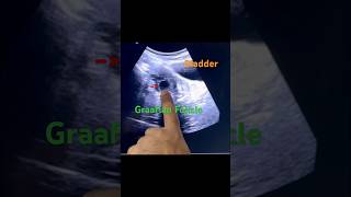 Graafian Follicle infertility pregnancyjourney bestultrasound baby ytshorts short pcod pcos [upl. by Scrope]