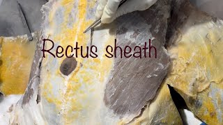 Rectus Sheath  dissection Dr Geetanjali Karle [upl. by Yrod]