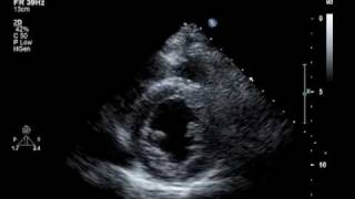 Hypokinesis Mitral Regurgitation Aortic Insufficiency [upl. by Van731]