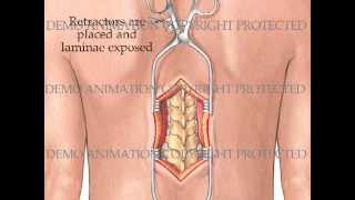 Transpedicular Thoracic Corpectomy [upl. by Decima]